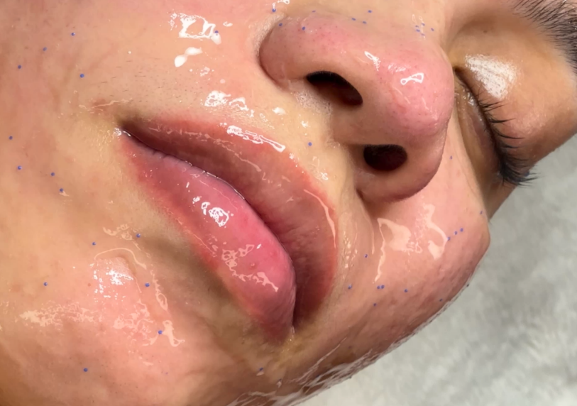 La mejor limpieza facial en Alto Prado