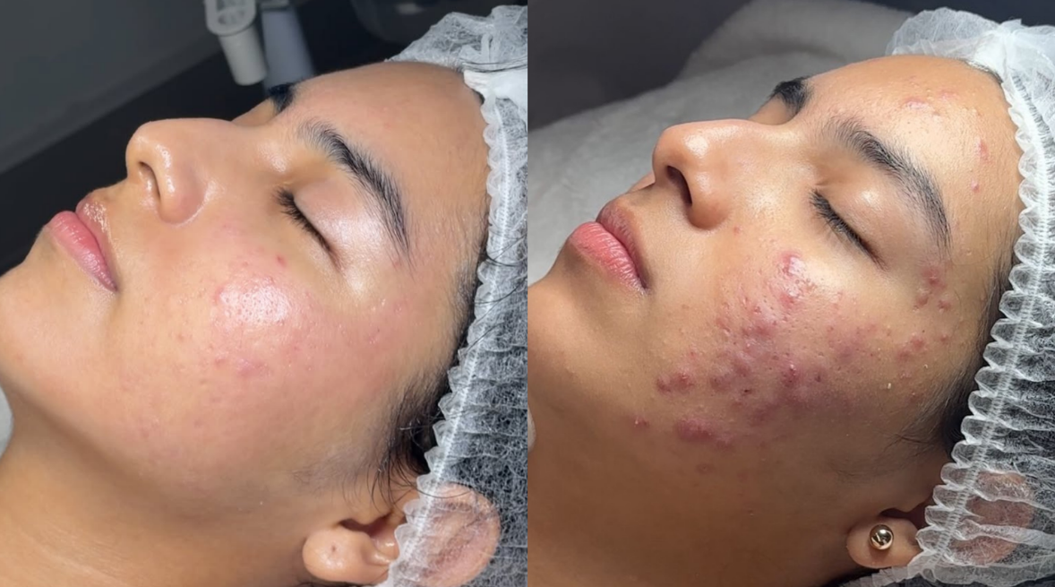 El método Glow Skin para tratar el acné