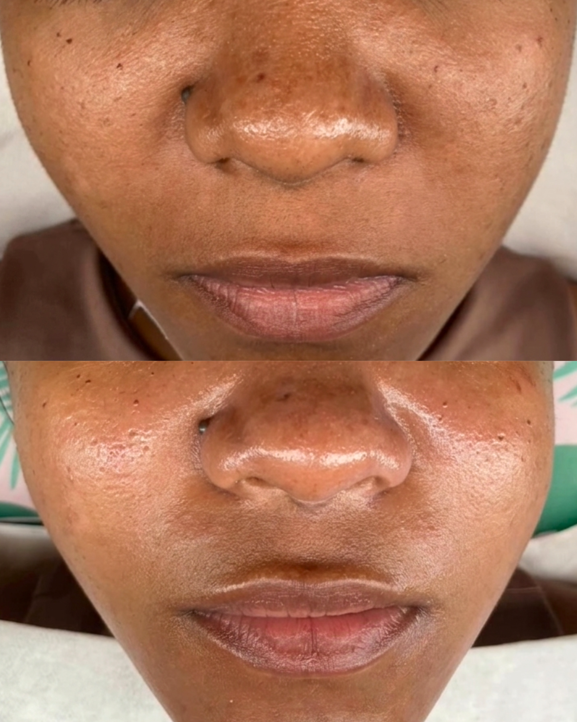 Caso 6 - Limpieza facial efecto descarga - Antes y después
