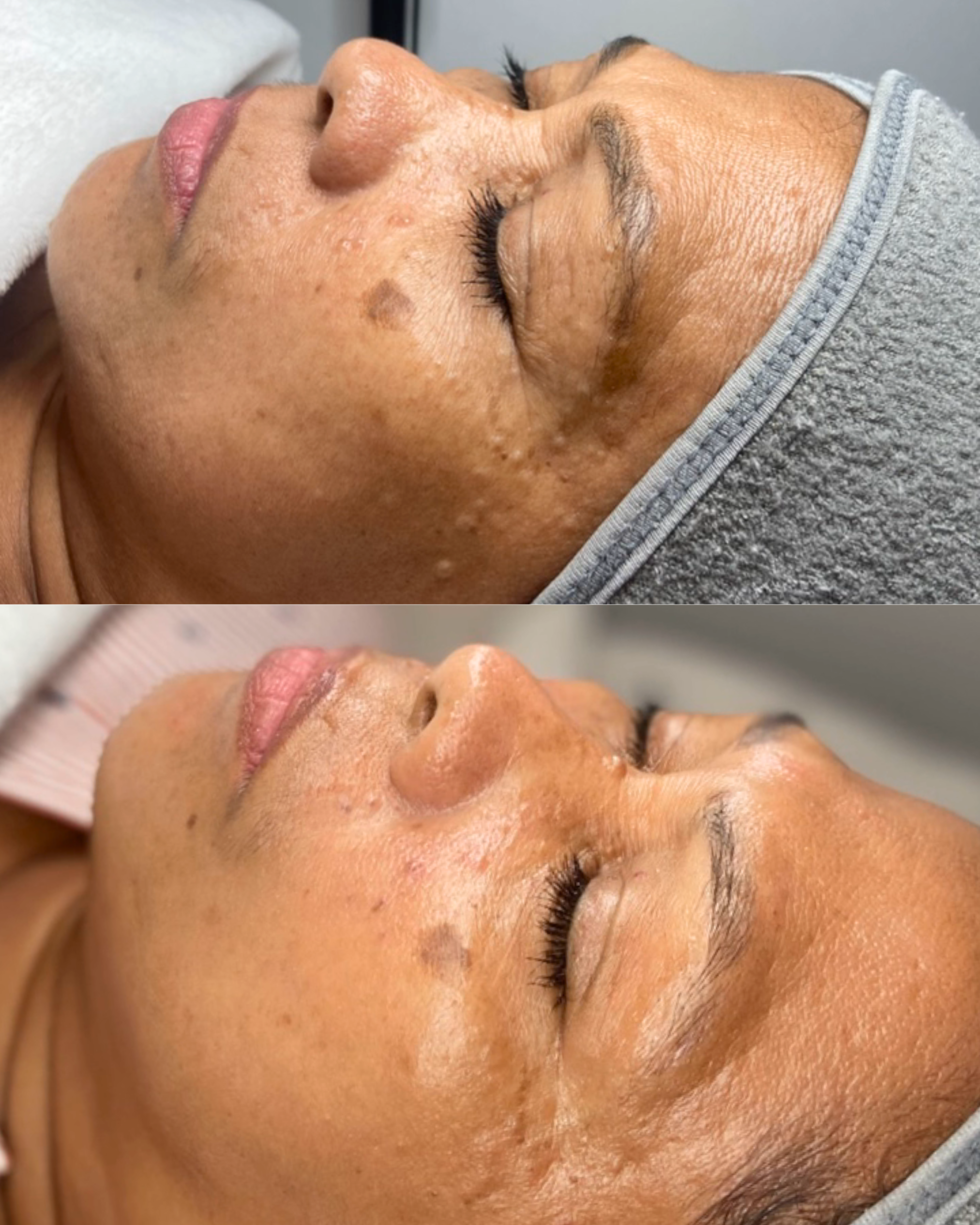 Caso 8 - Antioxpeelpro - Antes y después