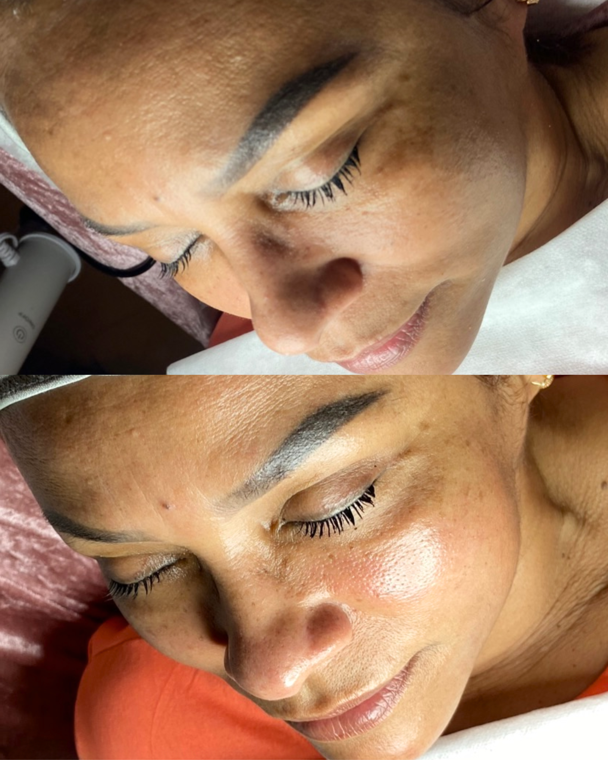 Caso 9 - Limpieza facial profunda - Antes y después