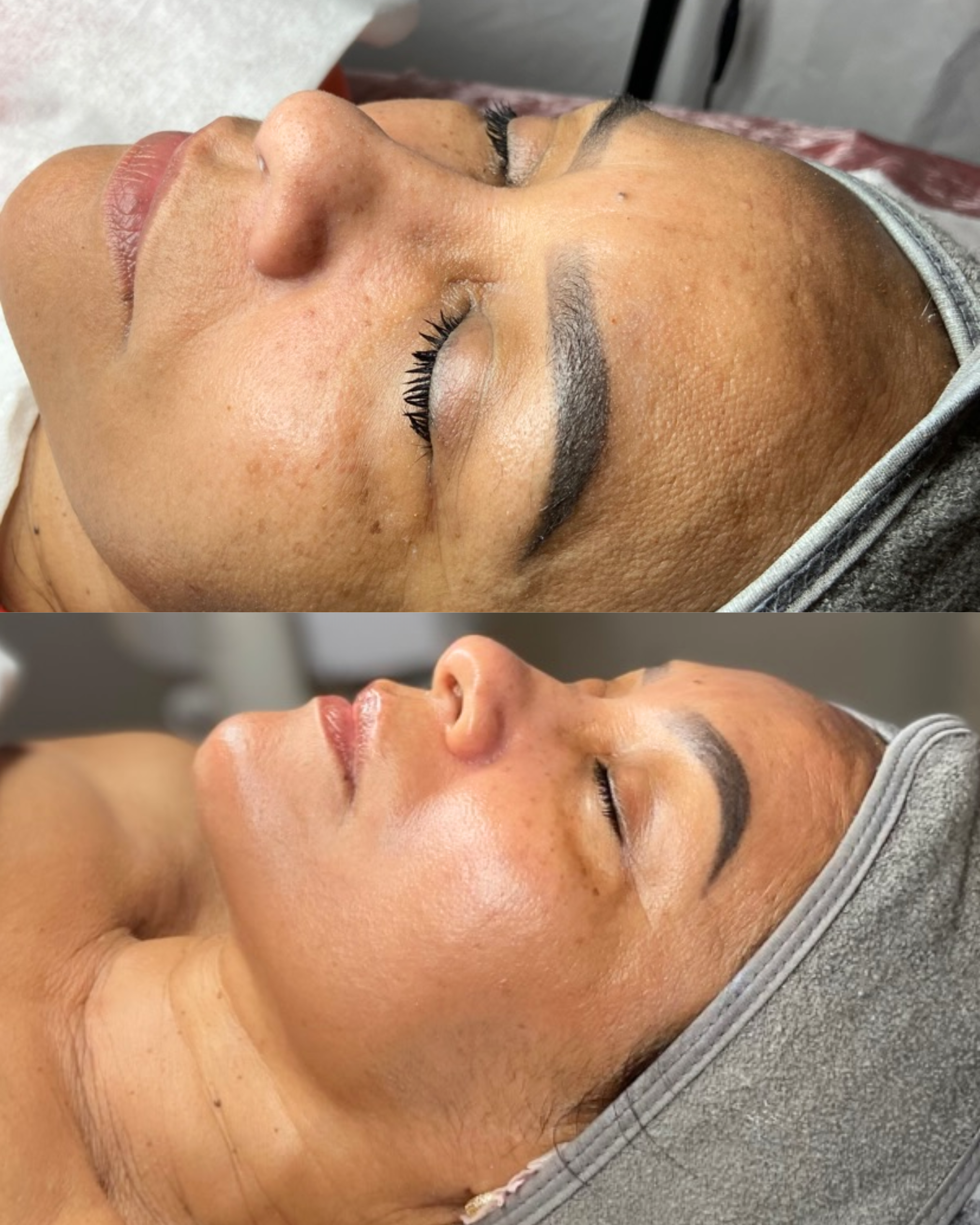 Caso 11 - Revitalización facial - Antes y después