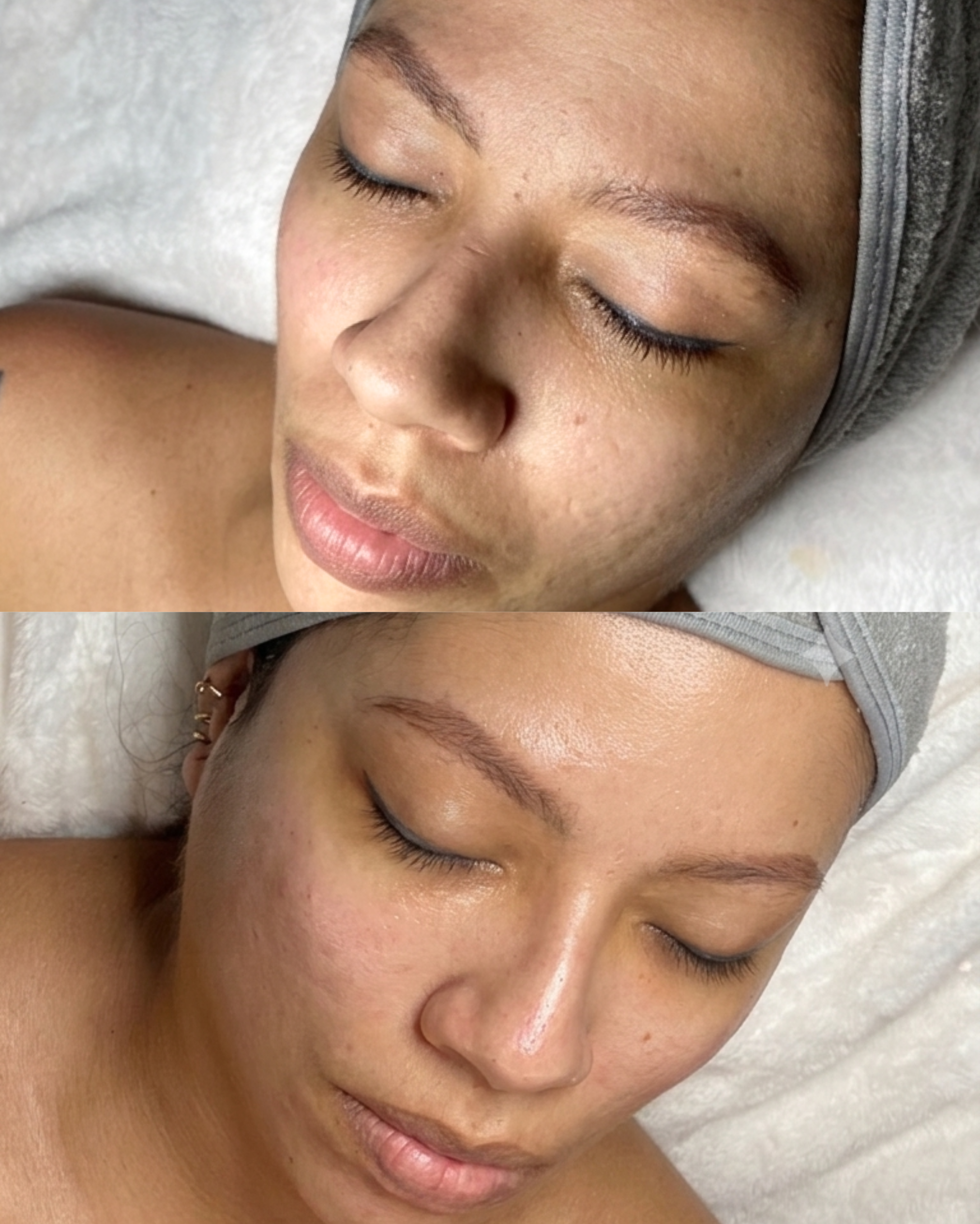 Caso 13 - Limpieza facial Glow Skin - Antes y después