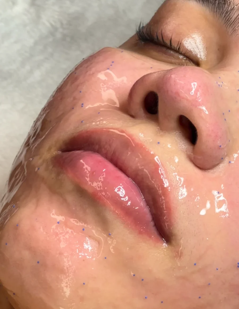 Peeling químico facial anti-acné Glow Skin